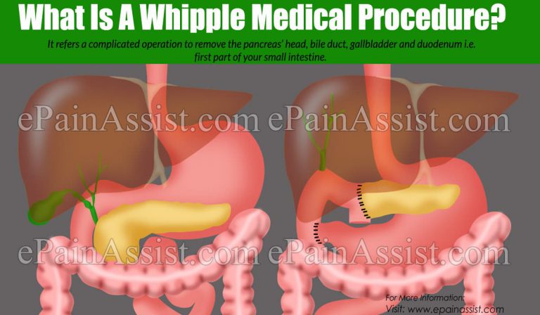 What Is A Whipple Medical Procedure?