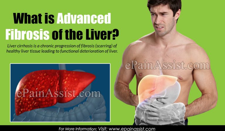 What is Advanced Fibrosis of the Liver?