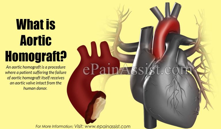 What is Aortic Homograft?