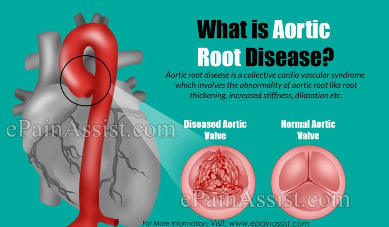 What is Aortic Root Disease?