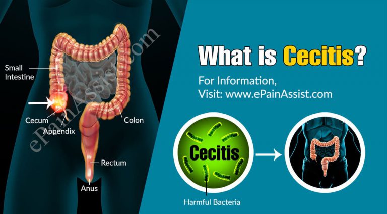 Cecitis: Causes, Symptoms, Treatments, Complications