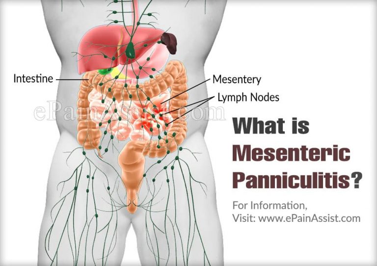 What Causes Mesenteric Panniculitis & How Is It Treated?