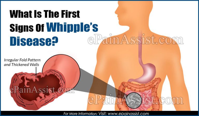 What Is The First Signs Of Whipple’s Disease?