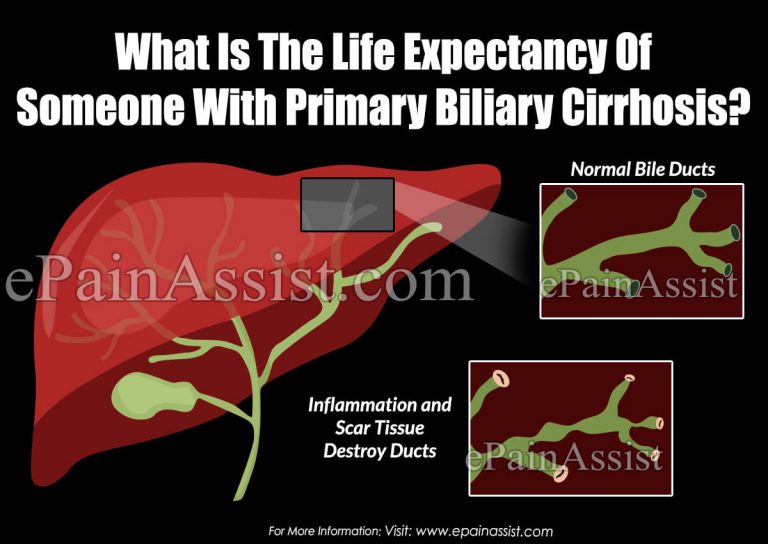 What Is The Life Expectancy Of Someone With Primary Biliary Cirrhosis?