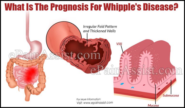 What Is The Prognosis For Whipple’s Disease?