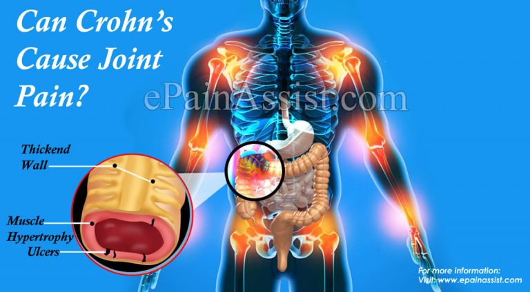 Can Crohn’s Cause Joint Pain?