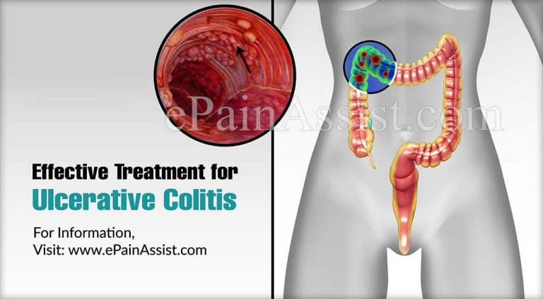 Steps To Take When Ulcerative Colitis Treatment Stops Working