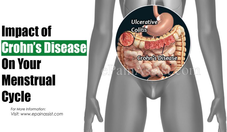 Impact of Crohn’s Disease On Your Menstrual Cycle