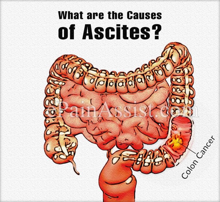 What is Ascites and Paracentesis?