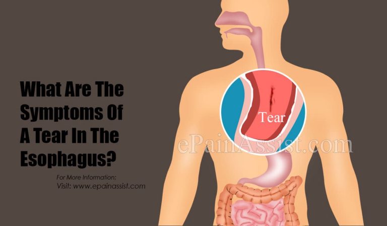 What Are The Symptoms Of A Tear In The Esophagus & Can An Esophagus Tear Heal Itself?