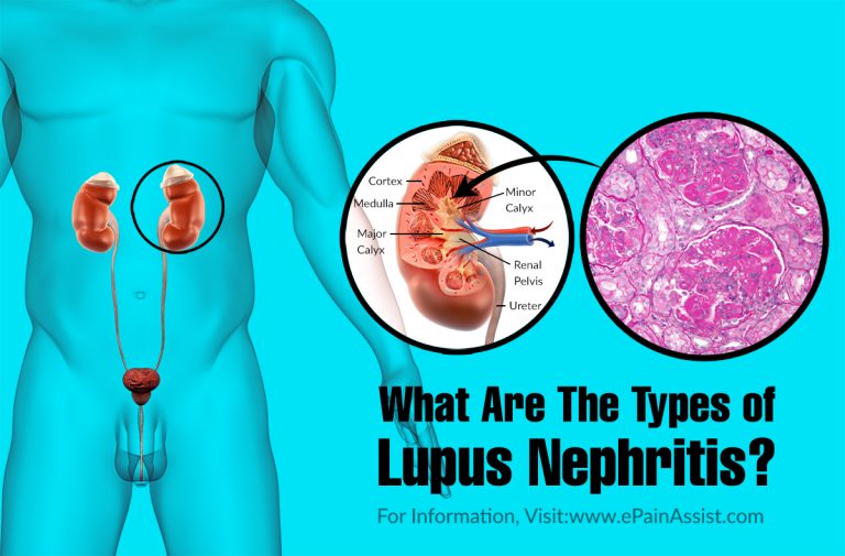 What Are The Types of Lupus Nephritis?