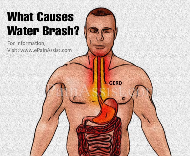 What is Water Brash & How is it Treated? | Causes, Symptoms of Water Brash