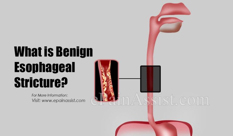 What is Benign Esophageal Stricture and How Is It Treated?