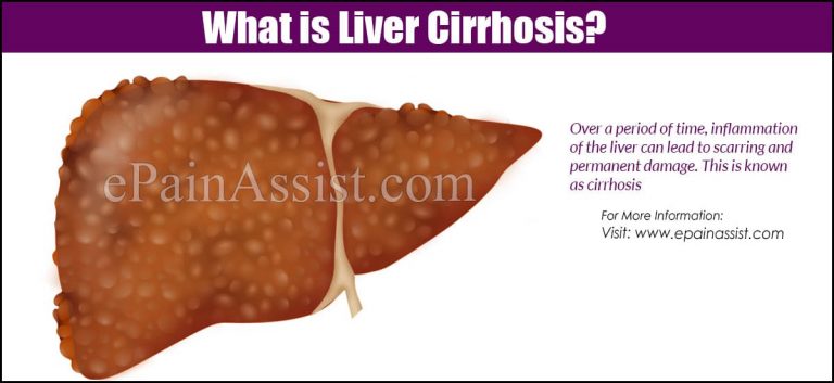 Hepatitis C and Cirrhosis: The Connection and Prognosis