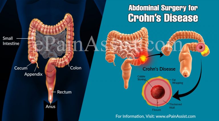 Abdominal Surgery for Crohn’s Disease: Recovery & Complications