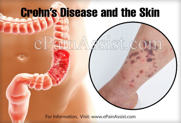 Crohn’s Disease and Skin: Symptoms, Causes & Treatment