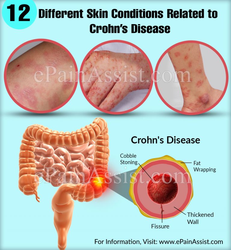 12 Different Skin Conditions Related to Crohn’s Disease