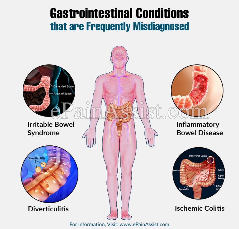 Gastrointestinal Conditions that are Frequently Misdiagnosed
