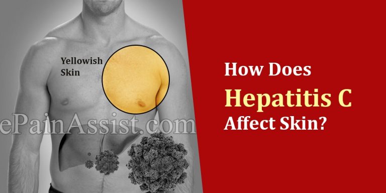 How Does Hepatitis C Affect Skin?