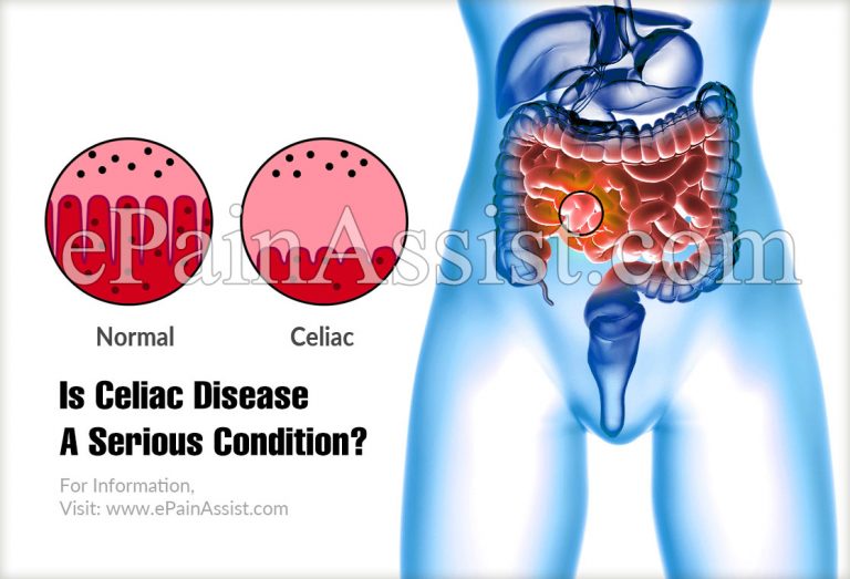 Is Celiac Disease A Serious Condition & Can It Be Reversed?