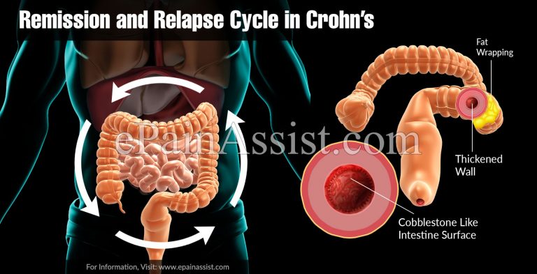Remission and Relapse Cycle in Crohn’s