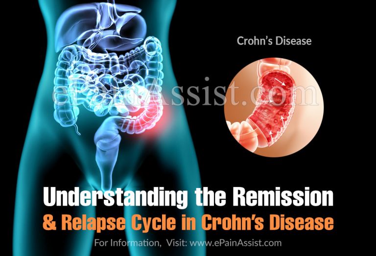 Understanding the Remission and Relapse Cycle in Crohn’s Disease