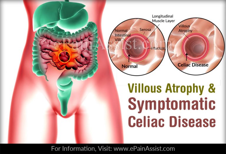 Factors Associated With Villous Atrophy In Symptomatic Celiac Disease Patients On A Gluten-Free Diet