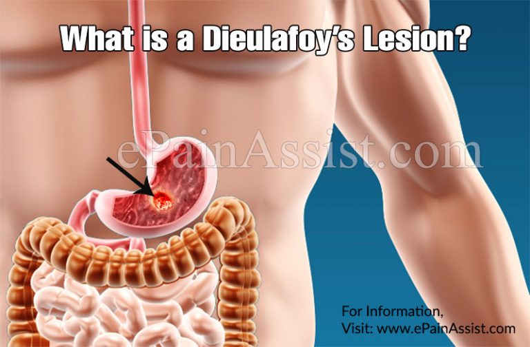 What is a Dieulafoy’s Lesion & How is it Treated?| Causes, Symptoms, Prognosis of Dieulafoy’s Lesion
