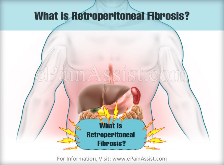 Retroperitoneal Fibrosis: Causes, Symptoms, Treatment, Complications, Diagnosis
