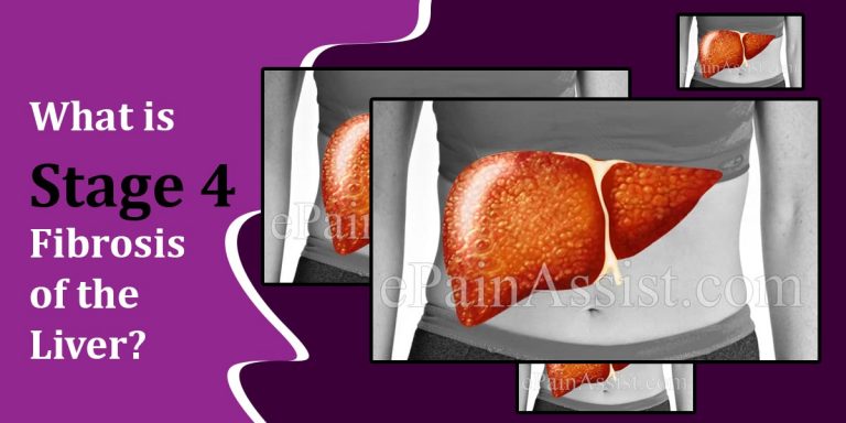 What is Stage 4 Fibrosis of the Liver?