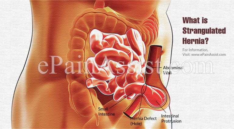 Strangulated Hernia: Causes, Symptoms, Treatment, Prognosis