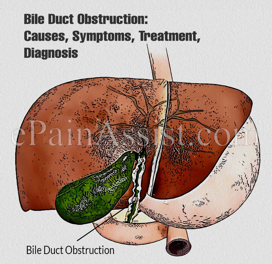 Bile Duct Obstruction: Causes, Symptoms, Treatment, Diagnosis