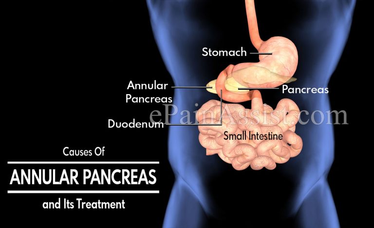 Causes Of Annular Pancreas and Its Treatment