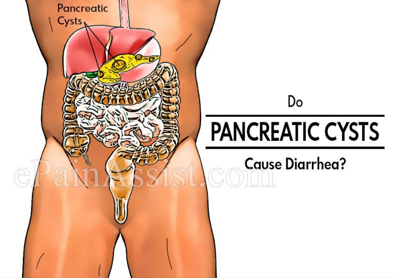 Do Pancreatic Cysts Cause Diarrhea & What Is The Best Treatment For It?