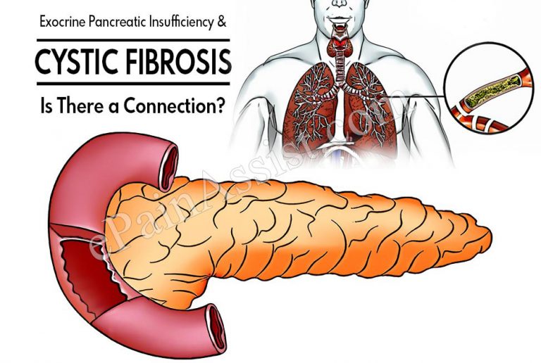 Exocrine Pancreatic Insufficiency and Cystic Fibrosis – Is There a Connection?