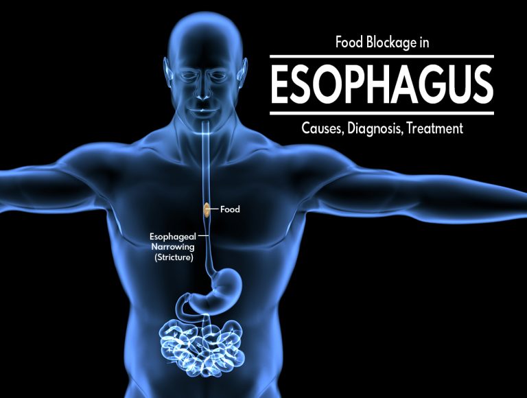 Food Blockage in the Esophagus: Causes, Diagnosis, Treatment, How to Handle Food Blockage in Esophagus