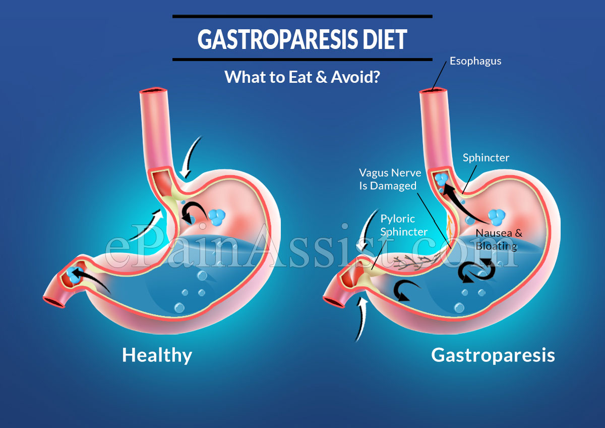 Gastroparesis Diet: What to Eat &amp; Avoid in Gastroparesis?