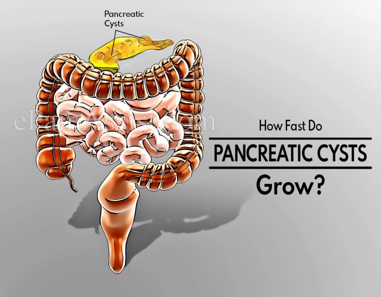 How Fast Do Pancreatic Cysts Grow & When Should They Be Removed?