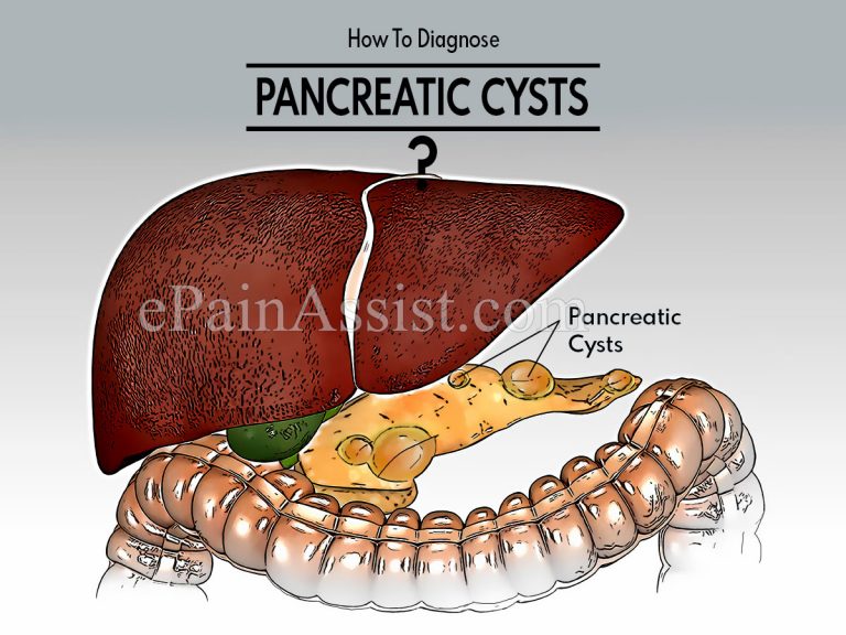 How To Diagnose Pancreatic Cysts & What Is The Best Medicine For It?