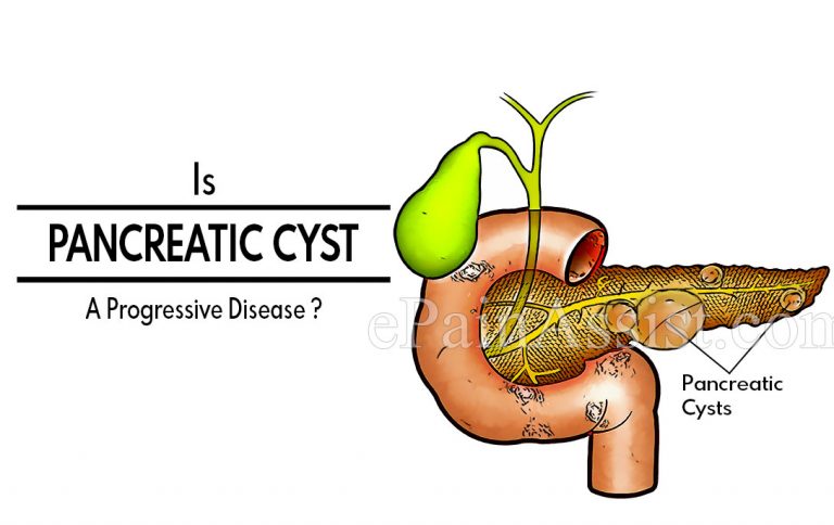 Is Pancreatic Cyst A Progressive Disease & Alternative Treatment For It?