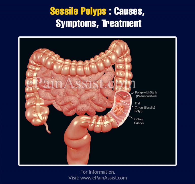 Sessile Polyps: Causes, Symptoms, Treatment