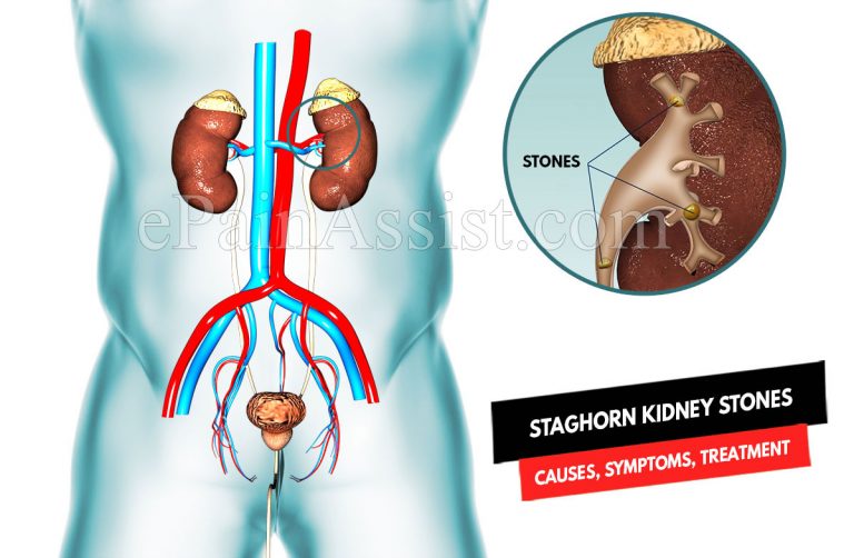 Staghorn Kidney Stones: Causes, Symptoms, Treatment, Prevention