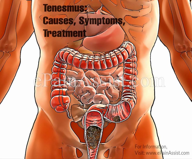 Tenesmus: Causes, Symptoms, Treatment