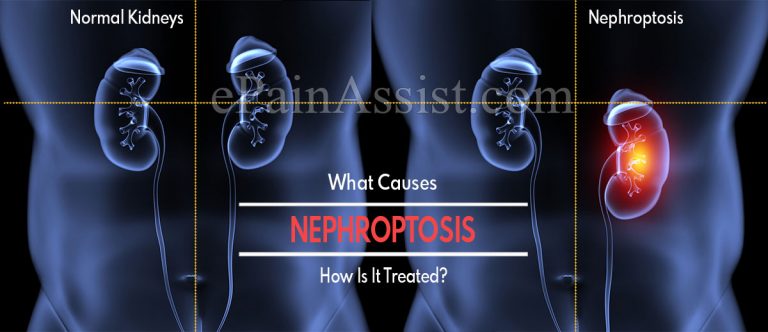What Causes Nephroptosis & How Is It Treated?