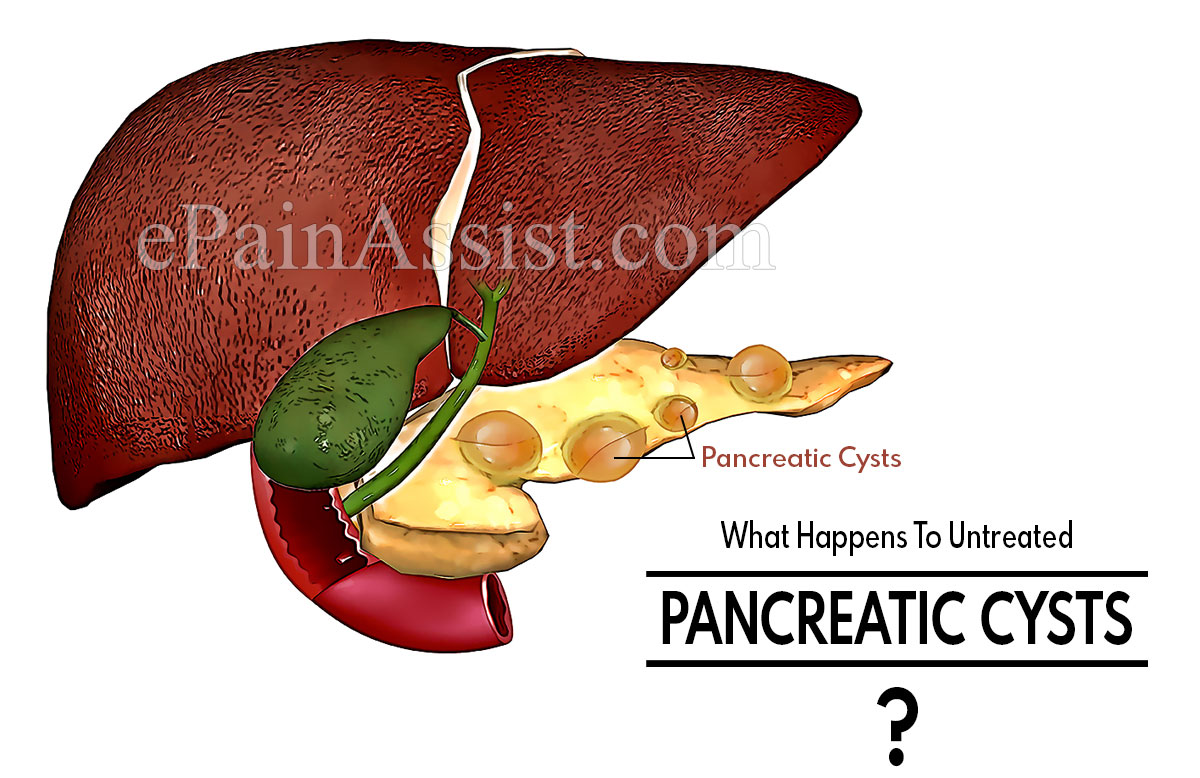 What Happens To Untreated Pancreatic Cysts?