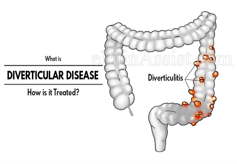 What is Diverticular Disease & How is it Treated? | Causes, Symptoms, Prevention and Diagnosis of Diverticular Disease