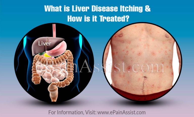 What is Liver Disease Itching & How is it Treated?