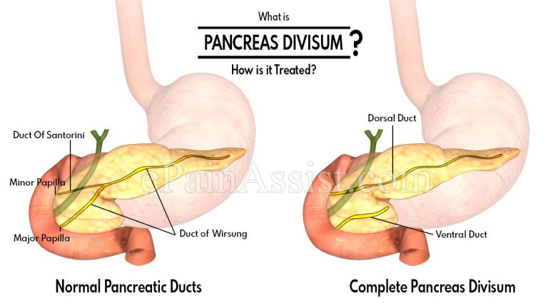 What is Pancreas Divisum & How is it Treated?