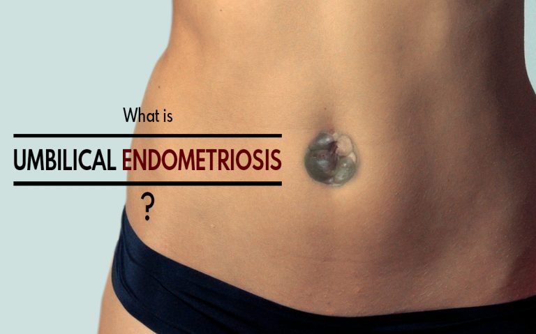 What is Umbilical Endometriosis & How is it Treated? | Causes, Signs and Symptoms of Umbilical Endometriosis