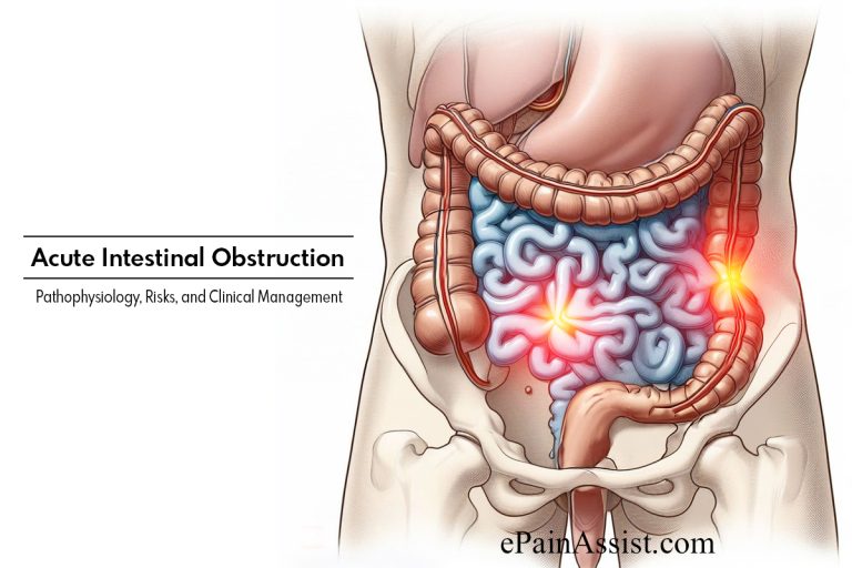 Acute Intestinal Obstruction : Pathophysiology, Risks, and Clinical Management